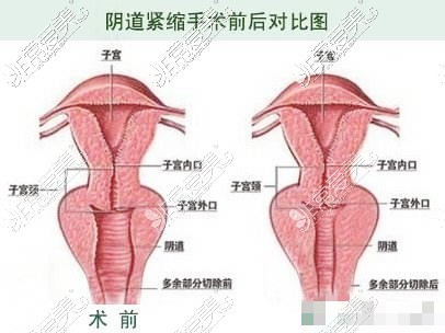 陰道緊縮術圖示