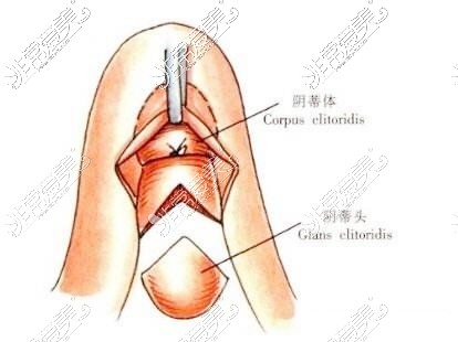 阴蒂整形图示