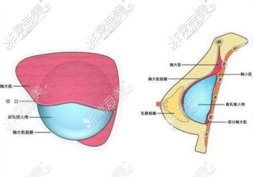 雙平面隆胸示意圖