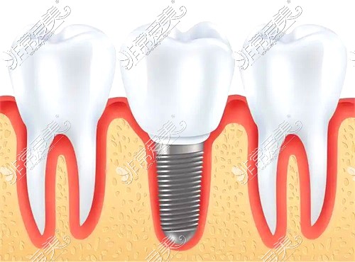  昌吉甄美口腔诊所种植牙示意图