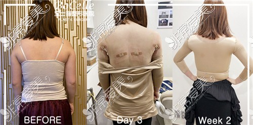 韩国宝士丽整形医院背部吸脂变化过程
