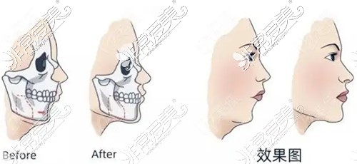 正颌手术前后对比图