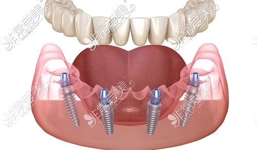 成都美呀口腔半口种植牙示意图