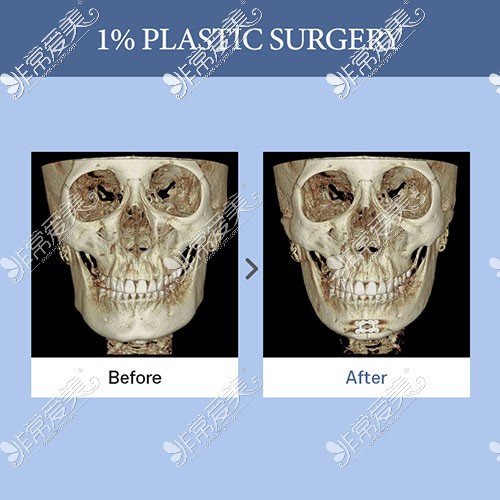 韩国1%整形外科下颌角整形