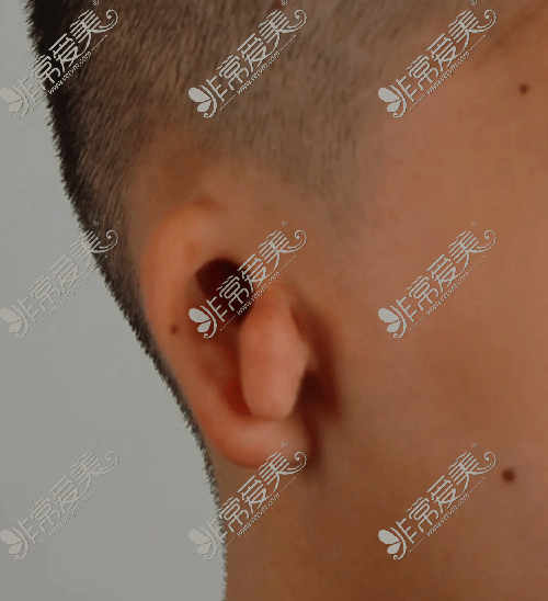 耳朵畸形照片