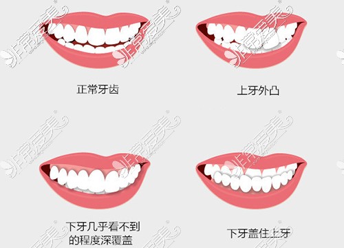 需要牙齿矫正的类型