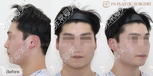 韩国1%整形外科男士面部轮廓手术前