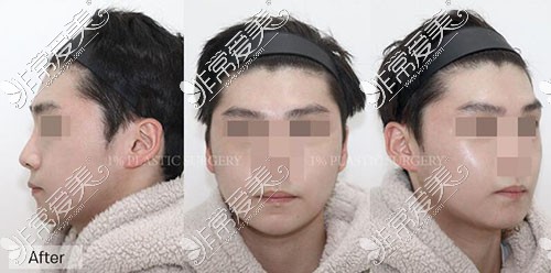 韩国1%整形外科男士面部轮廓手术后