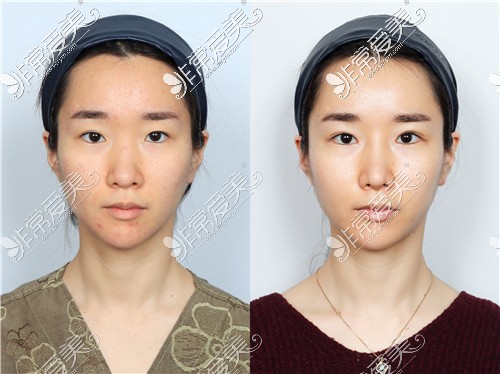 韩国爱乐整形外科眼鼻整形对比