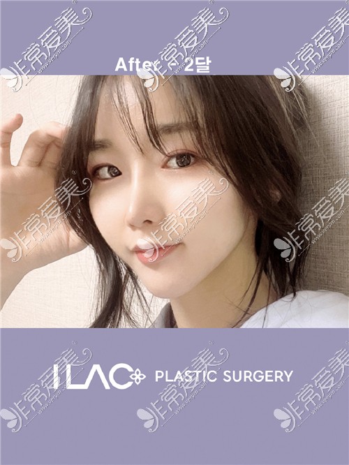 韩国爱乐整形外科眼鼻整形变化