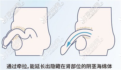 陰莖隱痕手術(shù)卡通圖