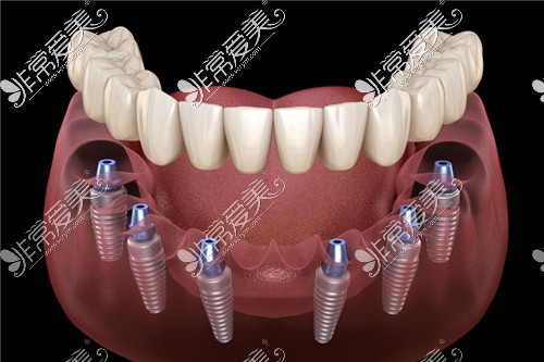 六颗半口种植牙图示