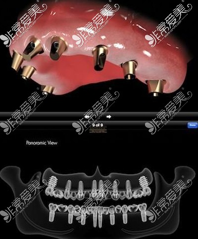 全口种植牙示意图