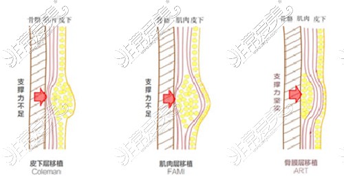 北京上上相医疗美容ART脂肪移植技术和其他技术对比