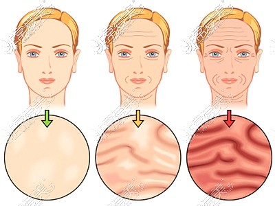 新疆整形医院皱纹示意图
