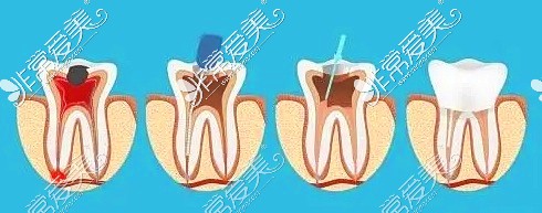 阿克蘇牙科醫(yī)院根管治療示意圖