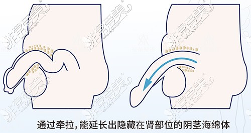 男性阴茎延长手术漫画