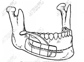 下颌手术部位图