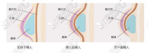 丰胸植入方式示意图