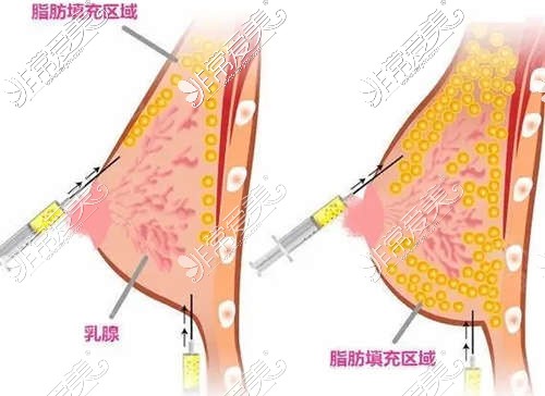 脂肪填充胸部前后