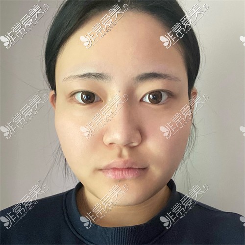 韩国ARC整形外科的眼综合+鼻综合+轮廓三件套术前