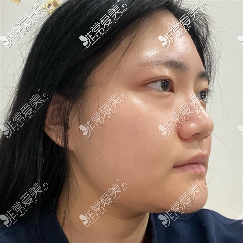 韩国ARC整形外科的眼综合+鼻综合+轮廓三件套手术前