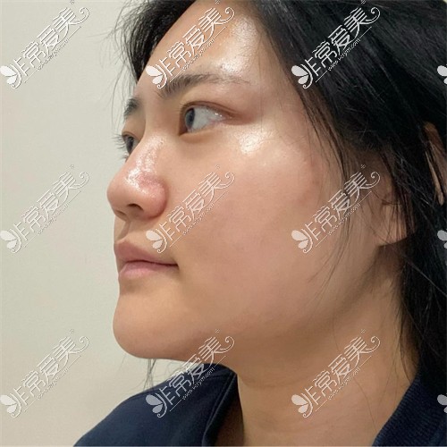 韩国ARC整形外科的眼综合+鼻综合+轮廓三件套术前图
