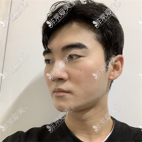 韩国ARC整形外科男士肋骨隆鼻术前图