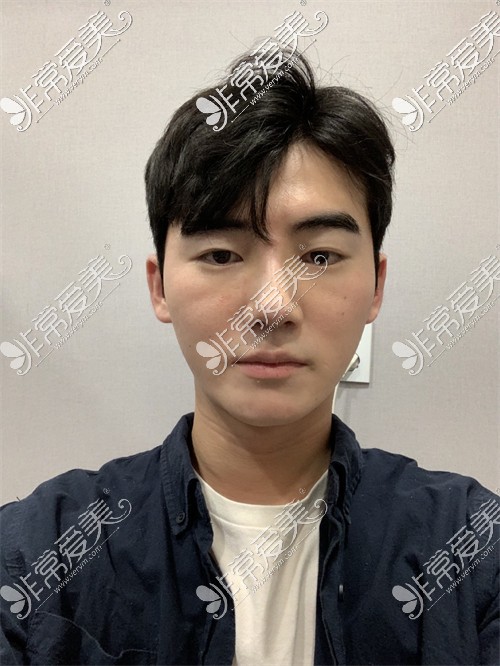 韩国ARC整形外科男士肋骨隆鼻术后14天