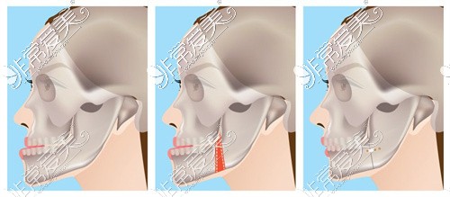 正颌手术示意图