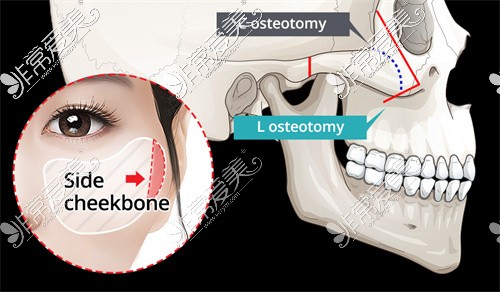 颧弓手术降低示意图