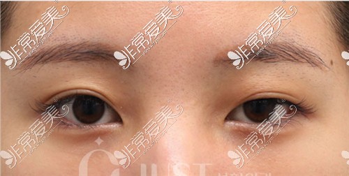 韩国JUST整形外科双眼皮手术+提肌手术术前