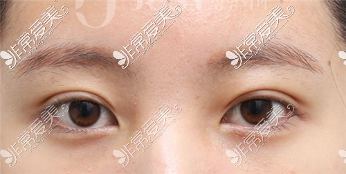 韩国JUST整形外科双眼皮手术+提肌手术术前术后