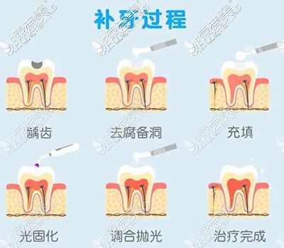 补牙的过程展示图