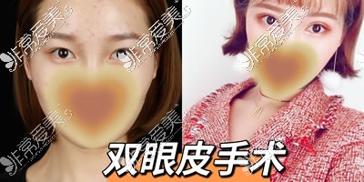 西安现代妇产医院美容科双眼皮手术