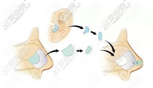 科普贴:歪鼻矫正手术成功率为多少,取决于医生和医院!