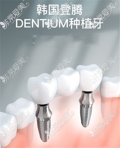 韩国登腾Dentium种植牙