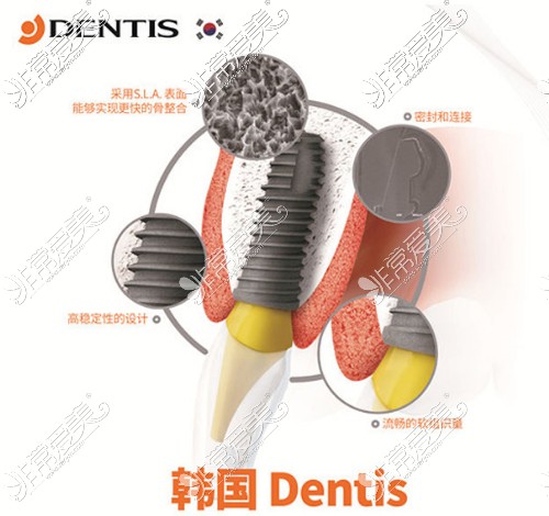 韩国登特斯dentis种植体