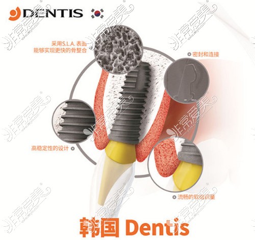 韓國登特斯dentis種植體