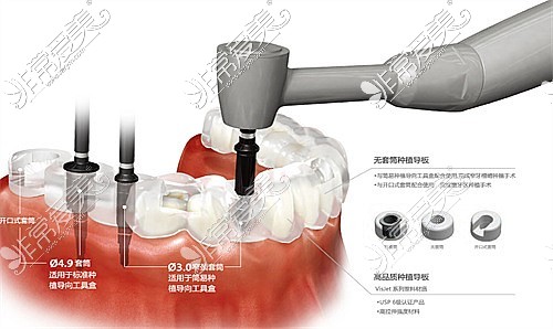 种植牙手术示意图