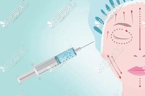 注射玻尿酸