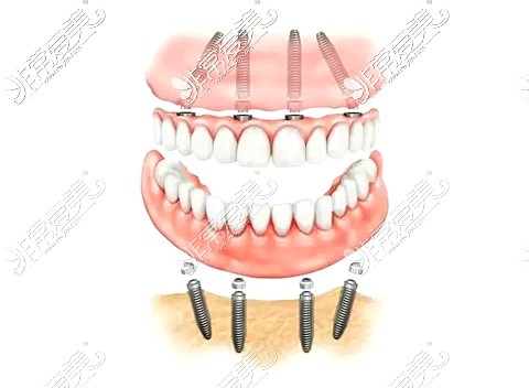 喀什牙科医院全口种植牙示意图