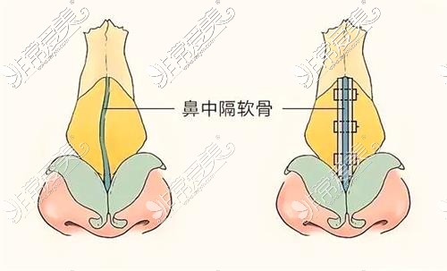 固定鼻中隔示意圖