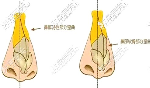 鼻软骨部分弯曲示意图