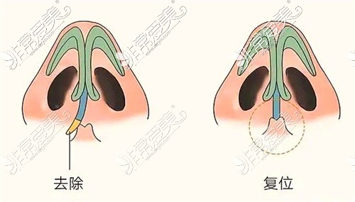 鼻子畸形矫正示意图