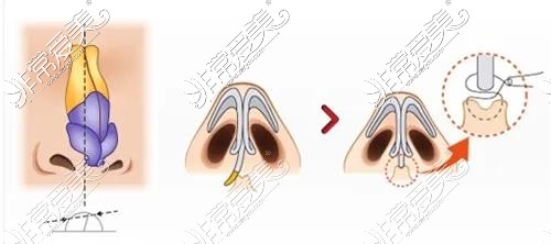 鼻中隔矫正示意图
