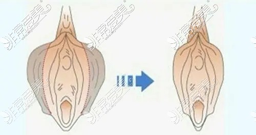 贵阳小阴唇手术