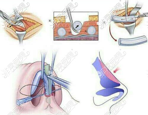 自体软骨隆鼻示意图