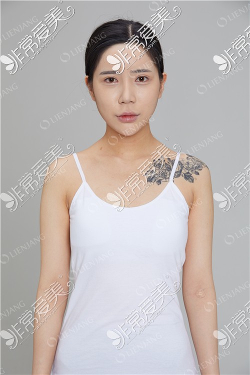 韩国丽延长整形隆胸术前图