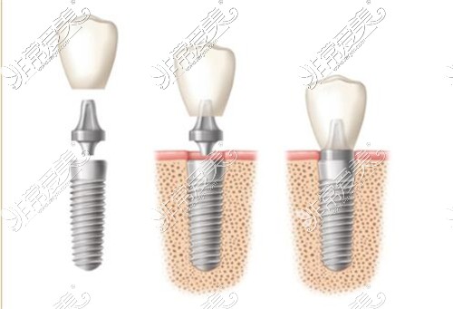 种植牙机构及植入后示意图